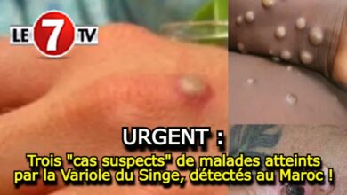 Photo of URGENT : Trois « cas suspects » de malades atteints par la Variole du Singe, détectés au Maroc !